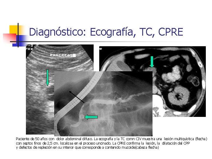 Diagnóstico: Ecografía, TC, CPRE Paciente de 50 años con dolor abdominal difuso. La ecografía