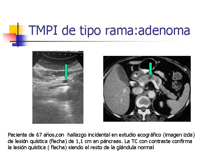 TMPI de tipo rama: adenoma Paciente de 67 años, con hallazgo incidental en estudio