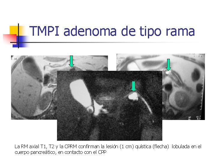 TMPI adenoma de tipo rama La RM axial T 1, T 2 y la