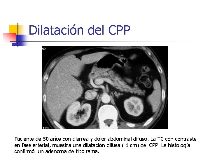 Dilatación del CPP Paciente de 50 años con diarrea y dolor abdominal difuso. La
