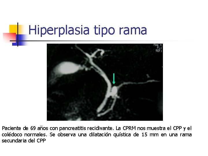 Hiperplasia tipo rama Paciente de 69 años con pancreatitis recidivante. La CPRM nos muestra