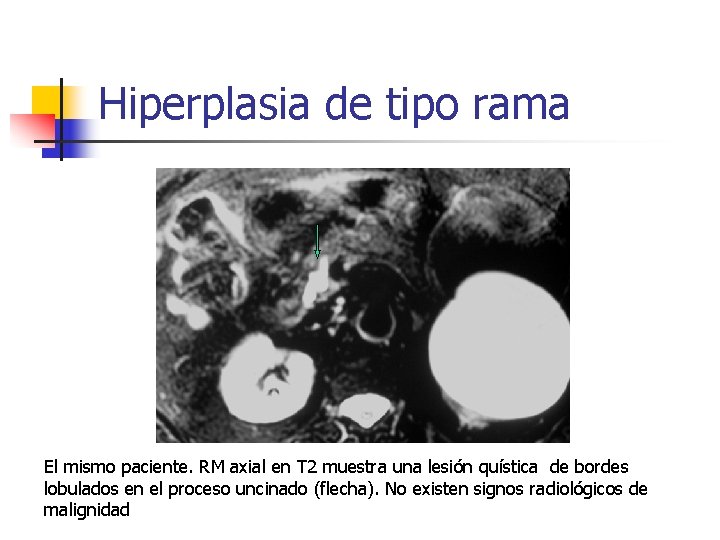 Hiperplasia de tipo rama El mismo paciente. RM axial en T 2 muestra una