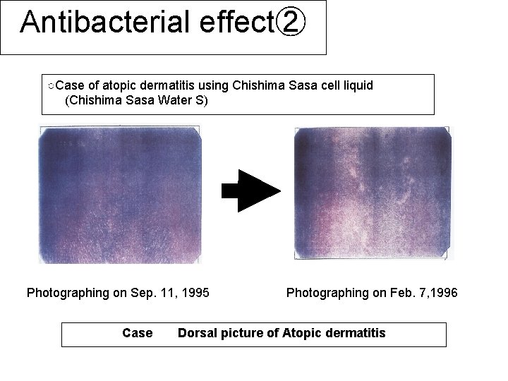 Antibacterial effect② ○Case of atopic dermatitis using Chishima Sasa cell liquid (Chishima Sasa Water