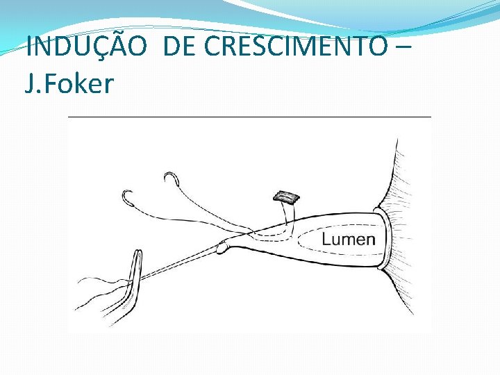 INDUÇÃO DE CRESCIMENTO – J. Foker 