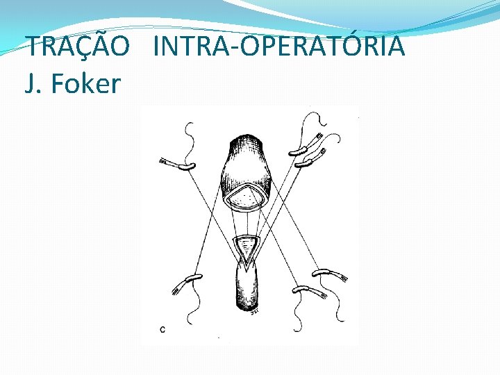 TRAÇÃO INTRA-OPERATÓRIA J. Foker 