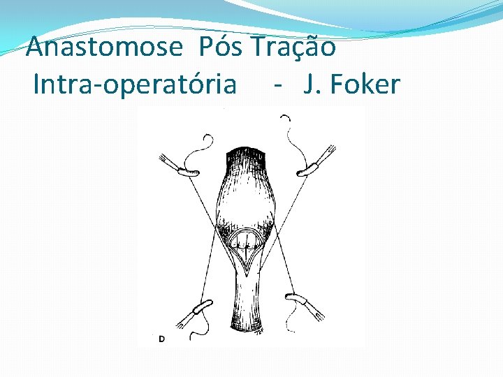 Anastomose Pós Tração Intra-operatória - J. Foker 