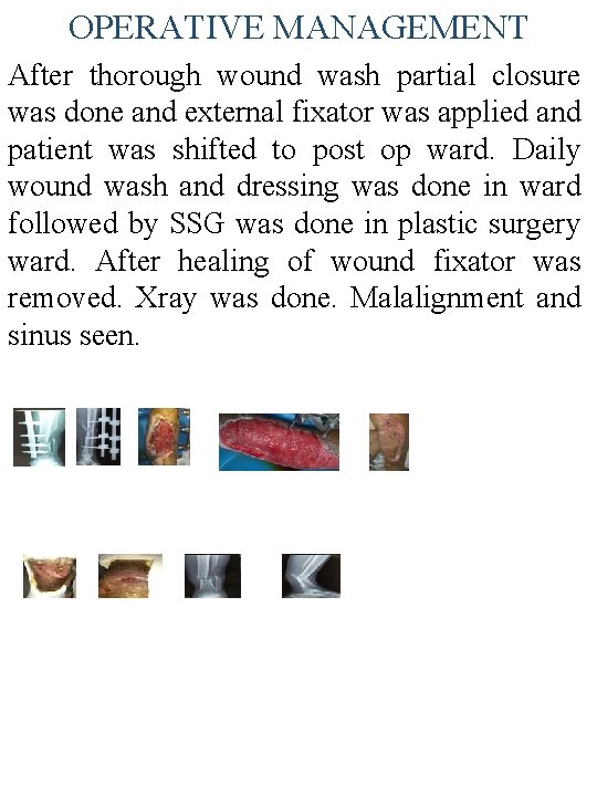 OPERATIVE MANAGEMENT After thorough wound wash partial closure was done and external fixator was