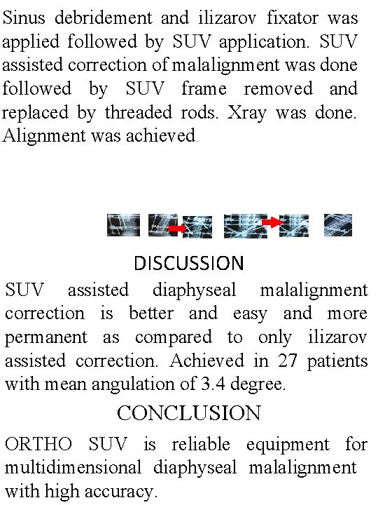 Sinus debridement and ilizarov fixator was applied followed by SUV application. SUV assisted correction