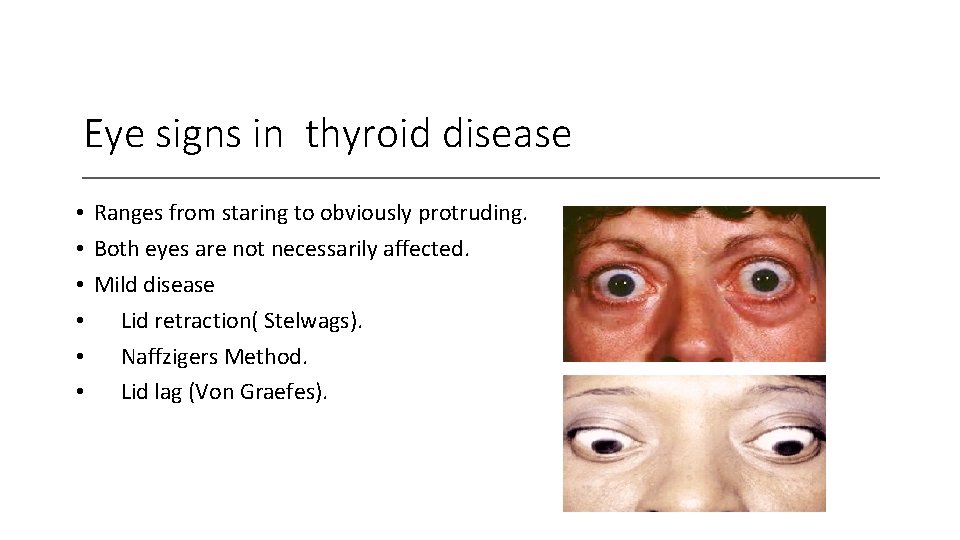 Eye signs in thyroid disease • Ranges from staring to obviously protruding. • Both