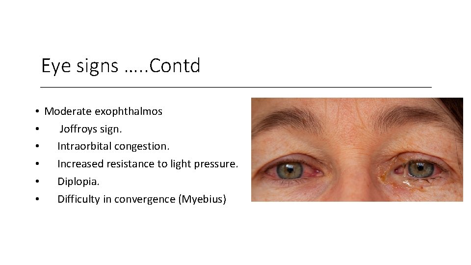 Eye signs …. . Contd • Moderate exophthalmos • Joffroys sign. • Intraorbital congestion.