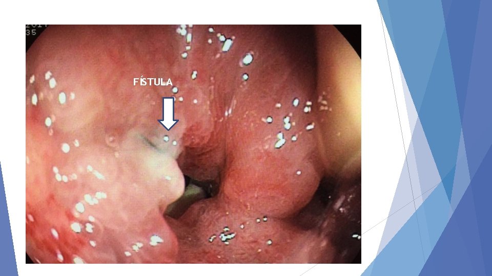 FÍSTULA 