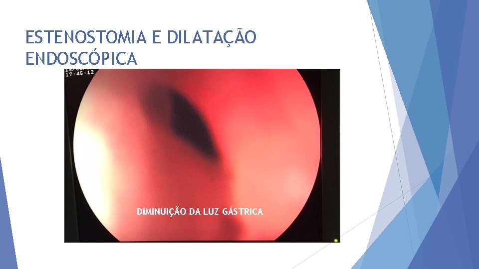 ESTENOSTOMIA E DILATAÇÃO ENDOSCÓPICA DIMINUIÇÃO DA LUZ GÁSTRICA 