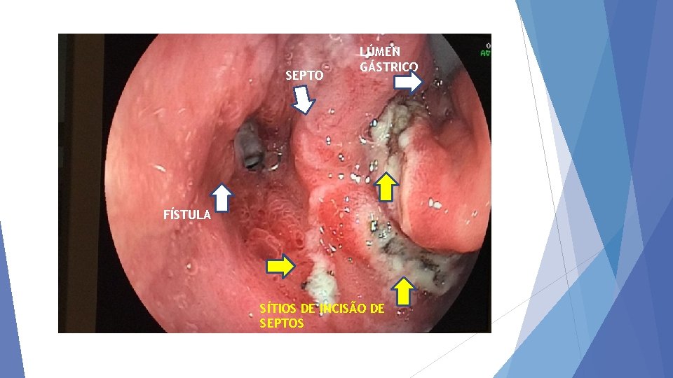 SEPTO LÚMEN GÁSTRICO FÍSTULA SÍTIOS DE INCISÃO DE SEPTOS 