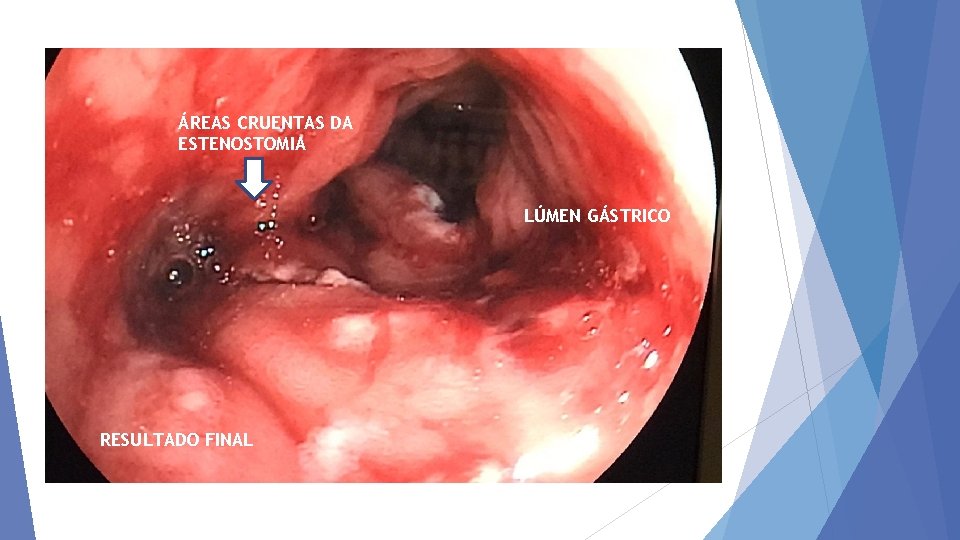 ÁREAS CRUENTAS DA ESTENOSTOMIA LÚMEN GÁSTRICO RESULTADO FINAL 