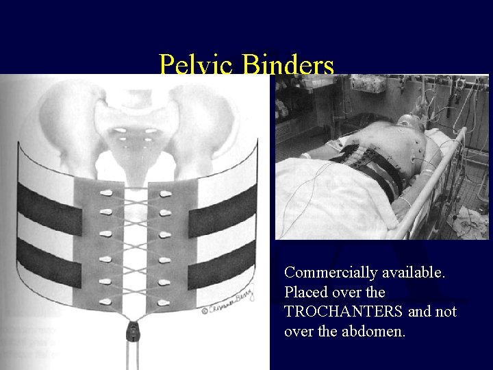 Pelvic Binders Commercially available. Placed over the TROCHANTERS and not over the abdomen. 