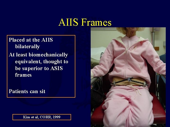 AIIS Frames Placed at the AIIS bilaterally At least biomechanically equivalent, thought to be