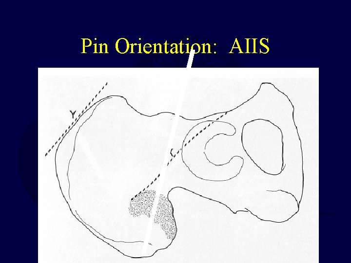 Pin Orientation: AIIS 