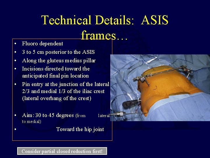 Technical Details: ASIS frames… Fluoro dependent • • 3 to 5 cm posterior to