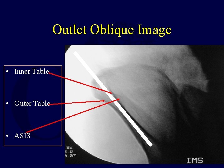 Outlet Oblique Image • Inner Table • Outer Table • ASIS 