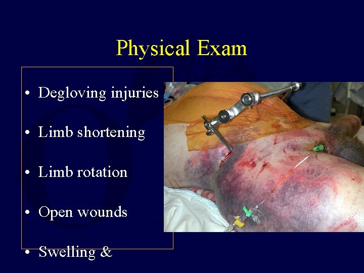 Physical Exam • Degloving injuries • Limb shortening • Limb rotation • Open wounds