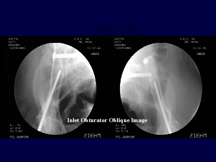 Inlet Obturator Oblique Image 