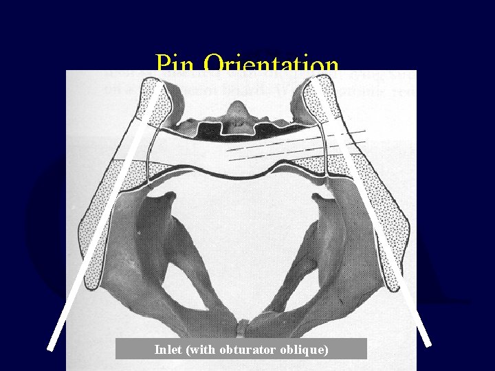 Pin Orientation Inlet (with obturator oblique) 