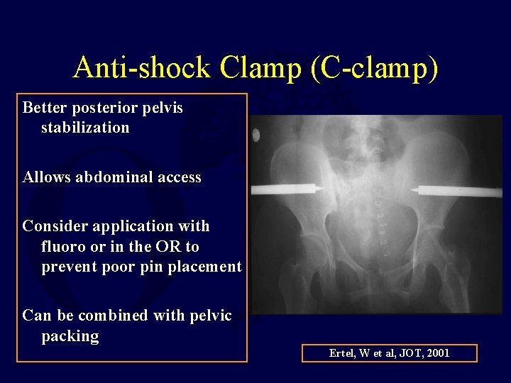 Anti-shock Clamp (C-clamp) Better posterior pelvis stabilization Allows abdominal access Consider application with fluoro