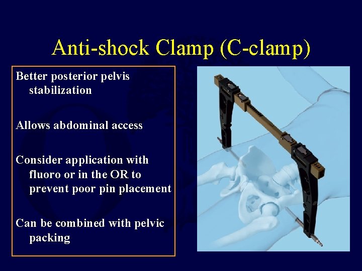 Anti-shock Clamp (C-clamp) Better posterior pelvis stabilization Allows abdominal access Consider application with fluoro