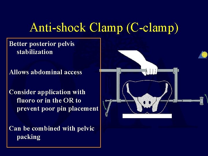 Anti-shock Clamp (C-clamp) Better posterior pelvis stabilization Allows abdominal access Consider application with fluoro