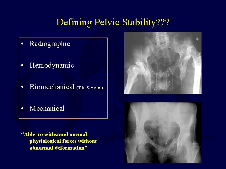 Defining Pelvic Stability? ? ? • Radiographic • Hemodynamic • Biomechanical (Tile & Hearn)