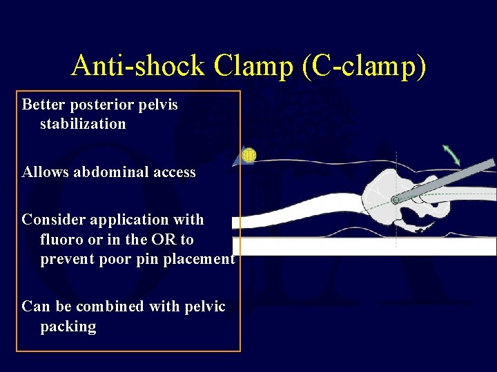 Anti-shock Clamp (C-clamp) Better posterior pelvis stabilization Allows abdominal access Consider application with fluoro