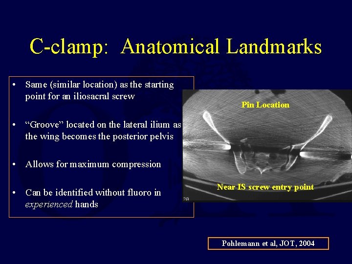 C-clamp: Anatomical Landmarks • Same (similar location) as the starting point for an iliosacral