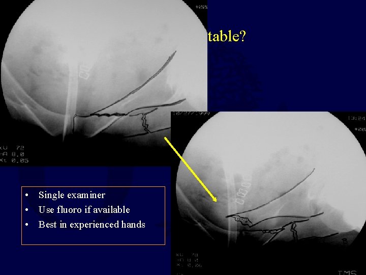 Stable or Unstable? • Single examiner • Use fluoro if available • Best in