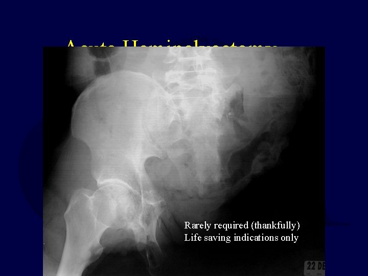 Acute Hemipelvectomy…. Rarely required (thankfully) Life saving indications only 