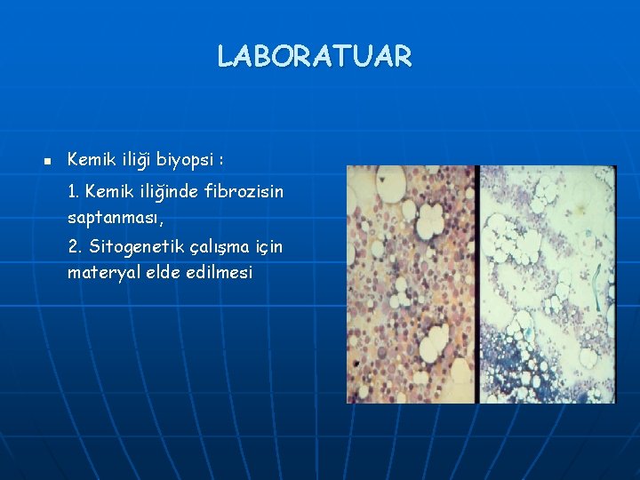 LABORATUAR n Kemik iliği biyopsi : 1. Kemik iliğinde fibrozisin saptanması, 2. Sitogenetik çalışma