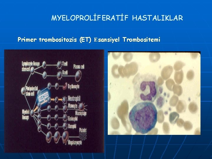 MYELOPROLİFERATİF HASTALIKLAR Primer trombositozis (ET) Esansiyel Trombositemi 