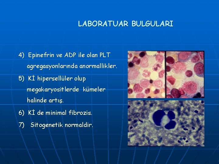 LABORATUAR BULGULARI 4) Epinefrin ve ADP ile olan PLT agregasyonlarında anormallikler. 5) Kİ hipersellüler LABORATUAR BULGULARI 4) Epinefrin ve ADP ile olan PLT agregasyonlarında anormallikler. 5) Kİ hipersellüler