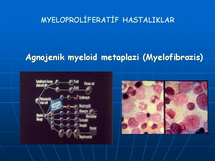 MYELOPROLİFERATİF HASTALIKLAR Agnojenik myeloid metaplazi (Myelofibrozis) 