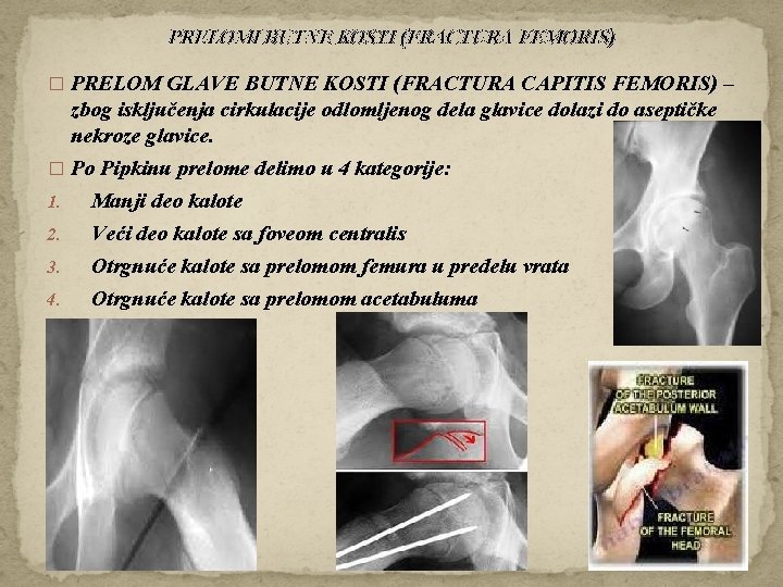 PRELOMI BUTNE KOSTI (FRACTURA FEMORIS) � PRELOM GLAVE BUTNE KOSTI (FRACTURA CAPITIS FEMORIS) –