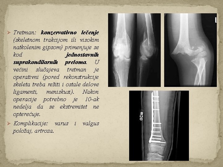 Ø Tretman: konzervativno lečenje (skeletnom trakcijom ili visokim natkolenim gipsom) primenjuje se kod jednostavnih