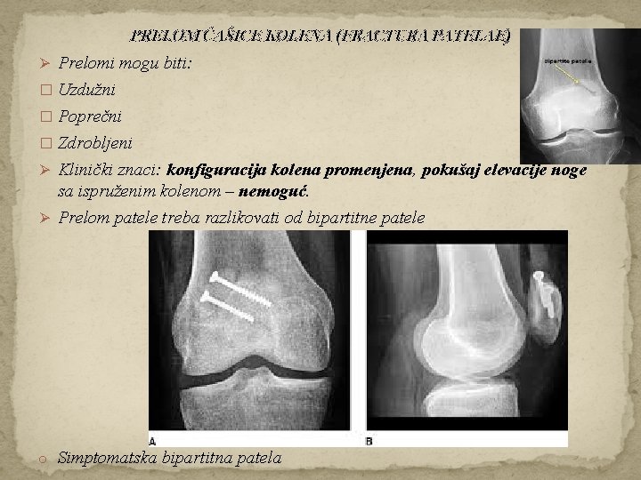 PRELOM ČAŠICE KOLENA (FRACTURA PATELAE) Ø Prelomi mogu biti: � Uzdužni � Poprečni �