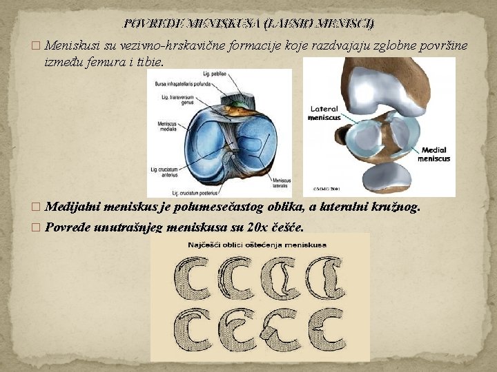 POVREDE MENISKUSA (LAESIO MENISCI) � Meniskusi su vezivno-hrskavične formacije koje razdvajaju zglobne površine između