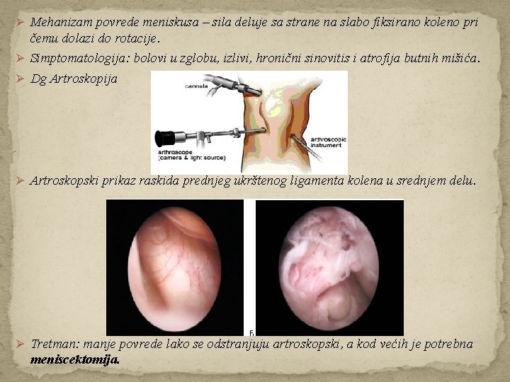 Ø Mehanizam povrede meniskusa – sila deluje sa strane na slabo fiksirano koleno pri