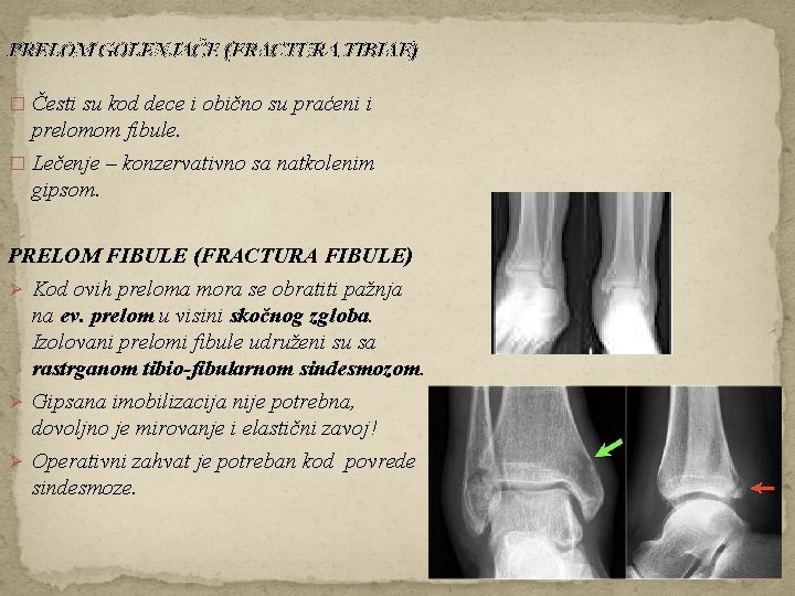 PRELOM GOLENJAČE (FRACTURA TIBIAE) � Česti su kod dece i obično su praćeni i