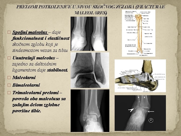 PRELOMI POTKOLENICE U NIVOU SKOČNOG ZGLOBA (FRACTURAE MALEOLARES) � Spoljni maleolus – daje funkcionalnost