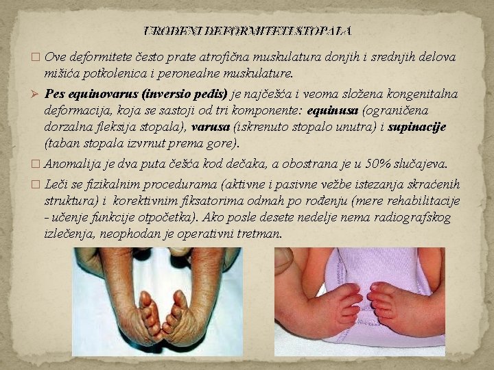 UROĐENI DEFORMITETI STOPALA � Ove deformitete često prate atrofična muskulatura donjih i srednjih delova