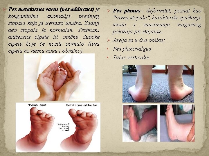 Ø Pes metatarsus varus (pes adductus) je Ø Pes planus - deformitet, poznat kao