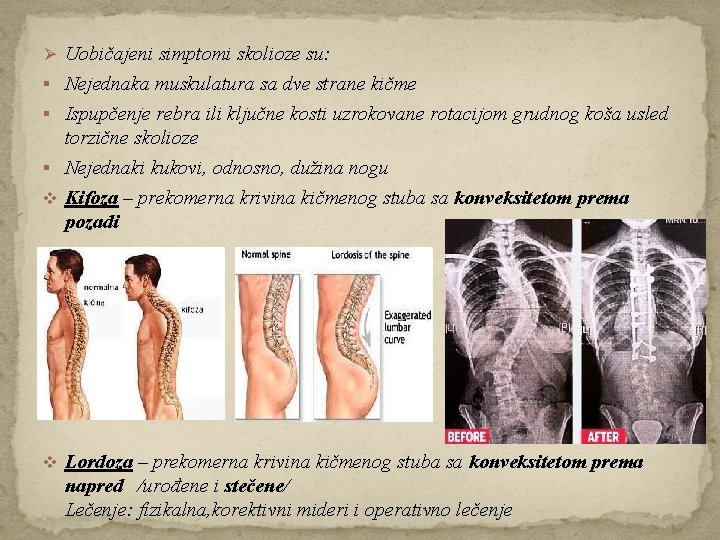 Ø Uobičajeni simptomi skolioze su: § Nejednaka muskulatura sa dve strane kičme § Ispupčenje