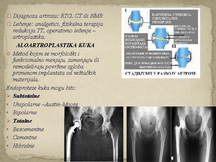 � Dijagnoza artroza: RTG, CT ili NMR � Lečenje: analgetici, fizikalna terapija redukcija TT,