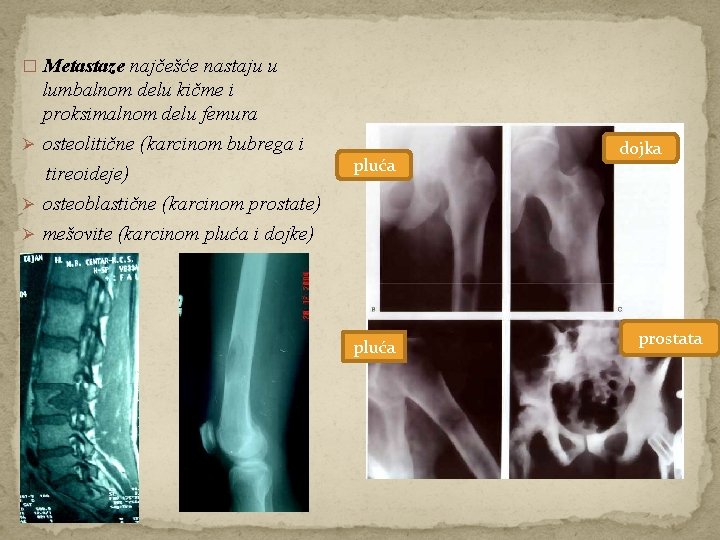 � Metastaze najčešće nastaju u lumbalnom delu kičme i proksimalnom delu femura Ø osteolitične